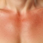Rote Brust nach dem Sport oder Urlaub? Ursachen und was du dagegen tun kannst